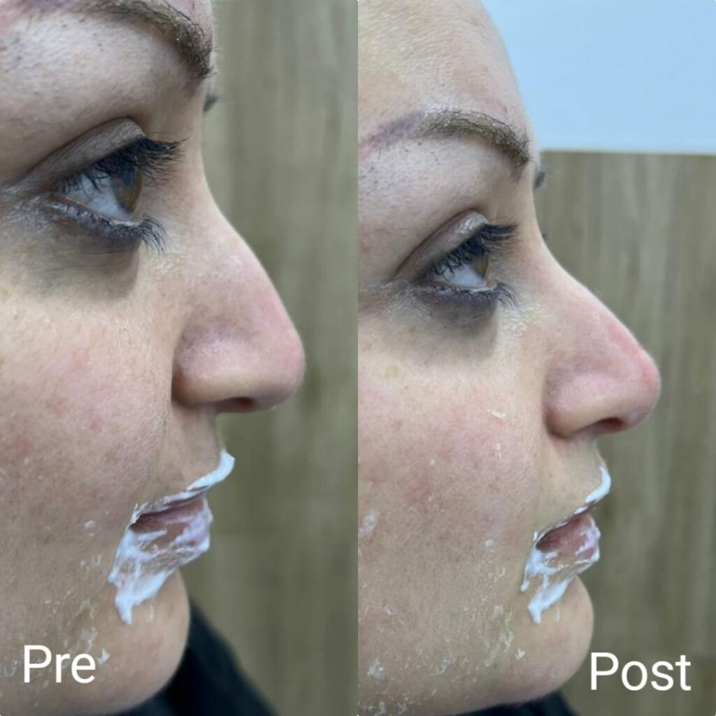 Nose filler before and after